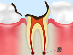 C4重度の虫歯