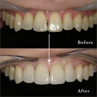 前歯部のラミネートベニア治療