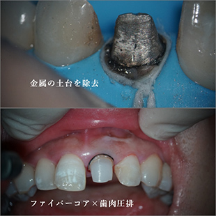 金属の土台が入っていた歯のセラミック治療