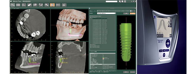 歯科用CT