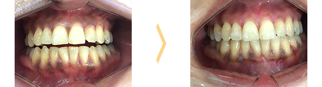 歯肉のメラニン色素沈着