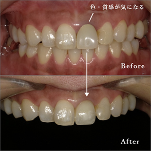 金属の土台が入っていた歯のセラミック治療