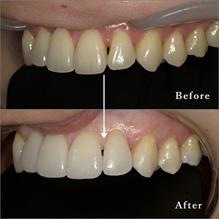 前歯部のラミネートベニア治療