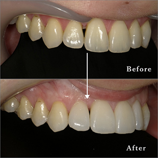 前歯部のラミネートベニア治療