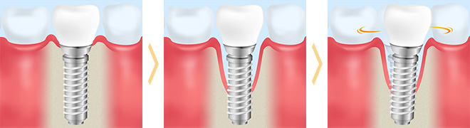 インプラント周囲炎について