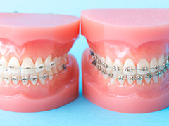 歯並びを改善するメリット