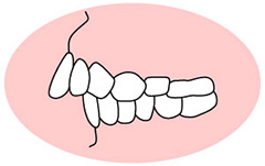 上顎前突（じょうがくぜんとつ）
