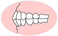 上下顎前突（じょうげがくぜんとつ）