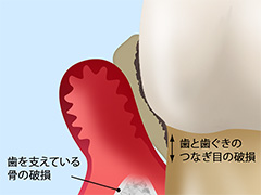 重度歯周炎（歯槽膿漏）